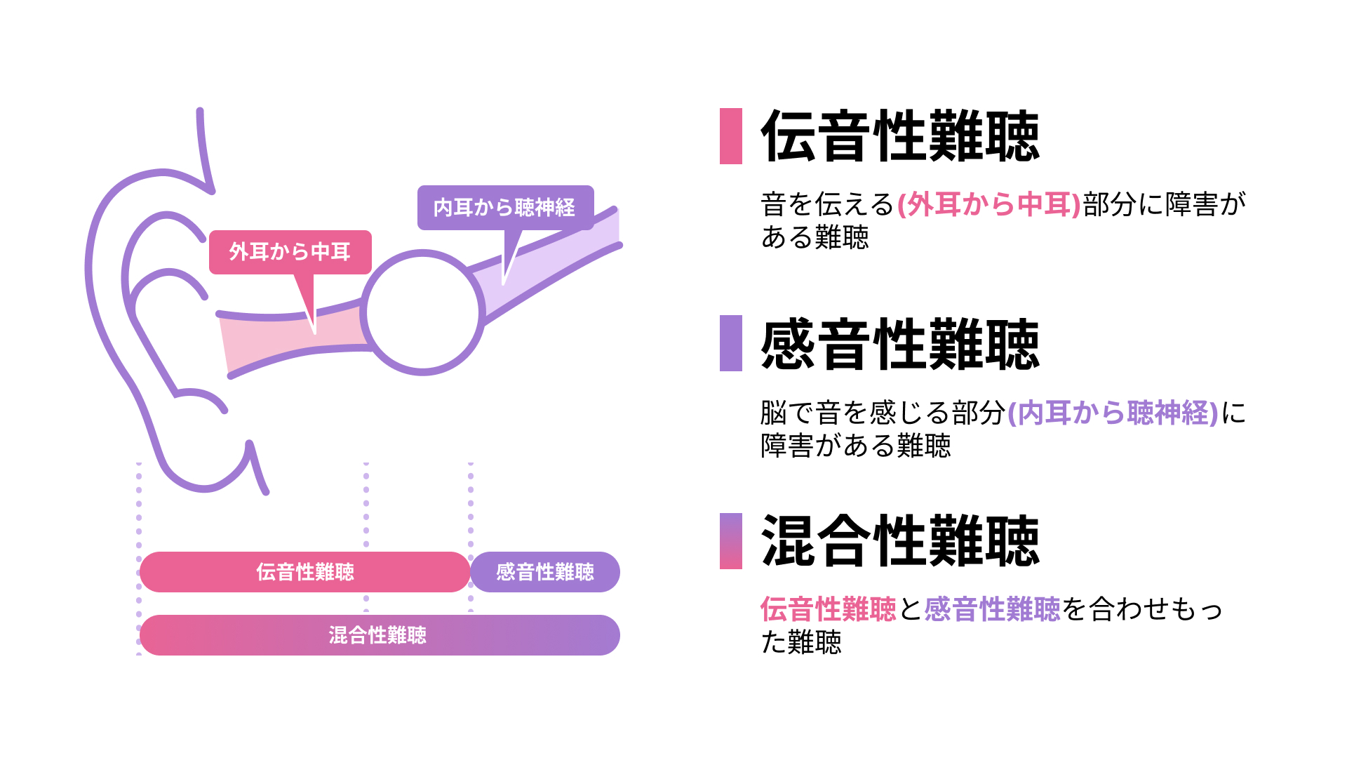 コレクション 感 音 性 難聴 イヤホン